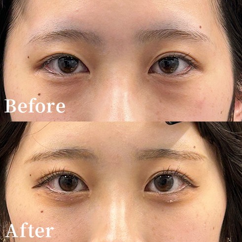 女性の下眼瞼脱脂