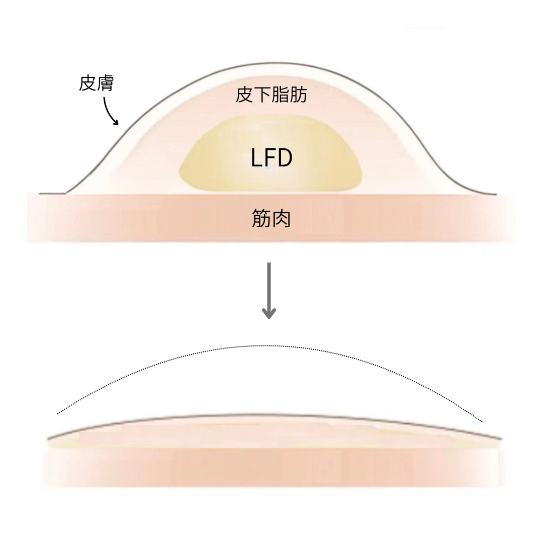 脂肪吸引術前後のLFD・皮下脂肪