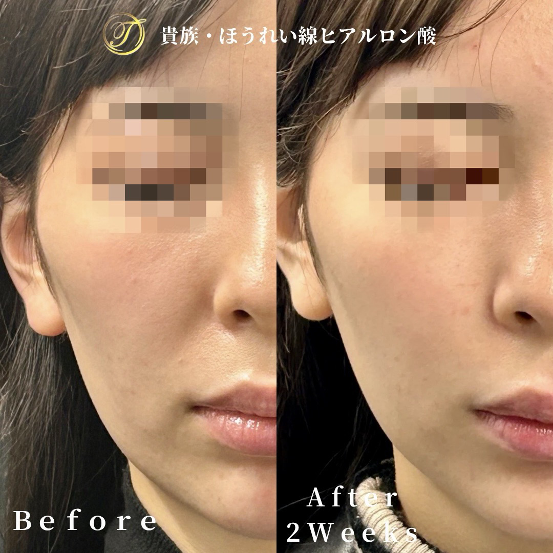 ほうれい線ヒアルロン酸ビフォーアフター