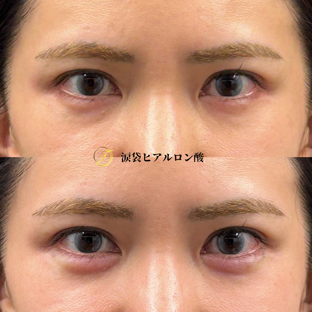 涙袋ヒアルロン酸ビフォーアフター
