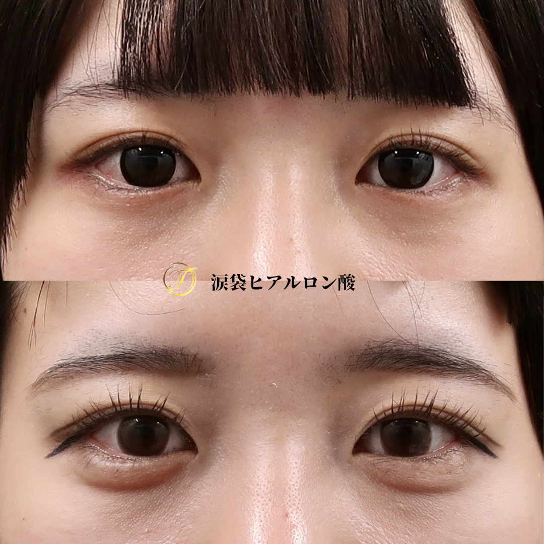 涙袋ヒアルロン酸ビフォーアフター