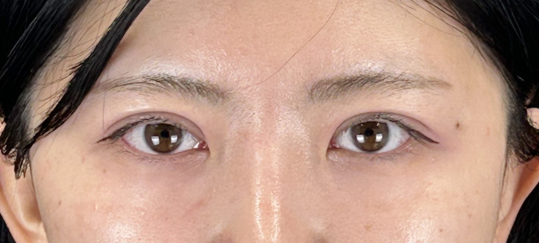 眼瞼下垂の手術後その①