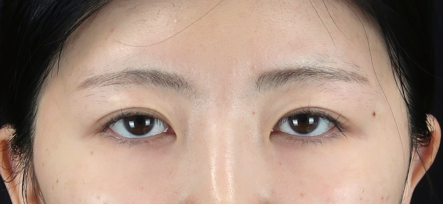 眼瞼下垂の手術前その①