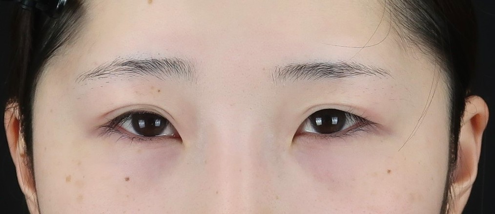 眼瞼下垂の手術前②