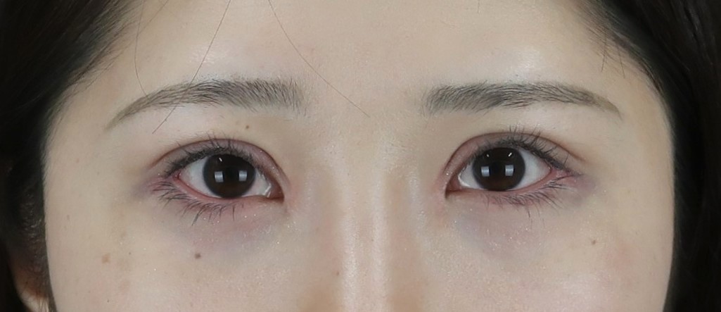 眼瞼下垂の手術後②