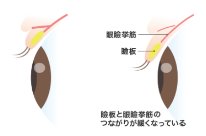 眼瞼下垂のイラスト